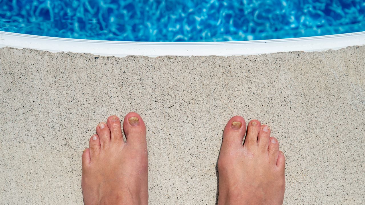tipos de hongos en los pies y como curarlos